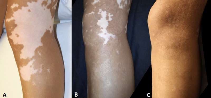 MKTP surgery has long-term benefit for restoring skin pigmentation in vitiligo patients