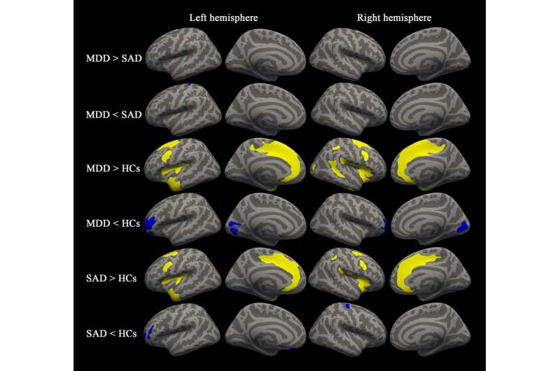 MRI uncovers brain abnormalities in people with depression and anxiety