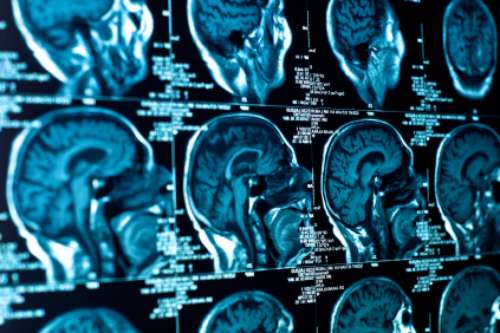 New guidelines could help improve research into vascular cognitive impairment