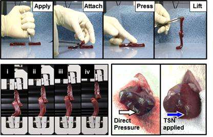 New harmless radiopaque glue to seal bleeding and guide surgery