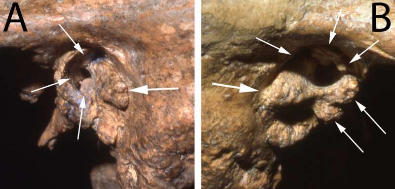 Older Neandertal survived with a little help from his friends