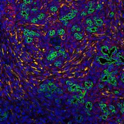 Pancreatic tumors rely on signals from surrounding cells
