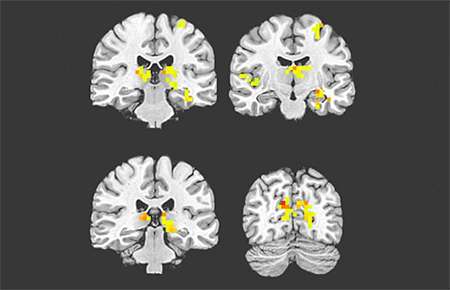 Stiff vessels, low blood flow in the brain forewarn of dementia