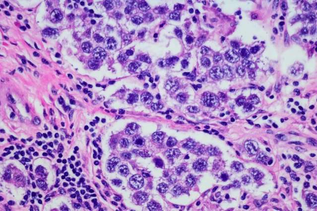 Study offers guidance for targeting residual ovarian tumors
