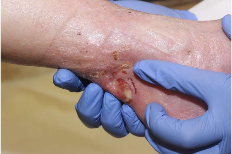 Topical gel made from oral blood pressure drugs shown effective in healing chronic wounds