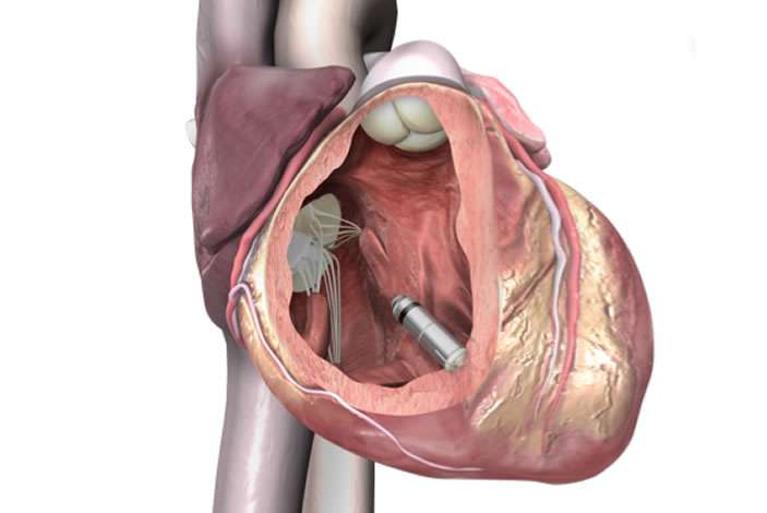 World's smallest, leadless pacemaker yields positive results