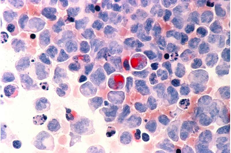 Researchers show p300 protein may suppress leukemia in MDS patients