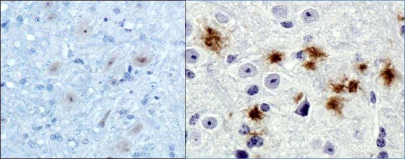 Researchers help unlock the molecular origins of Alzheimer's disease