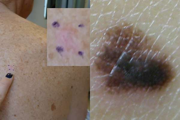 Researchers look to improve detection of skin cancer lacking pigment melanin