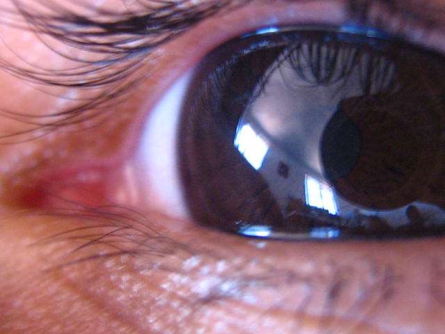 Breakthrough discovery provides glimmer of hope to prevent blindness