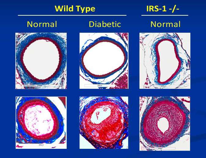 Researchers implicate suspect in heart disease linked to diabetes