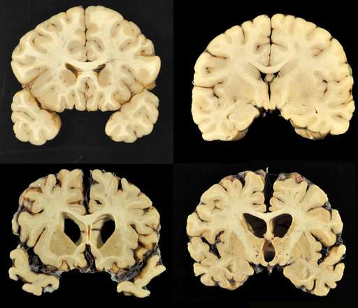 Brain disease seen in most football players in large report