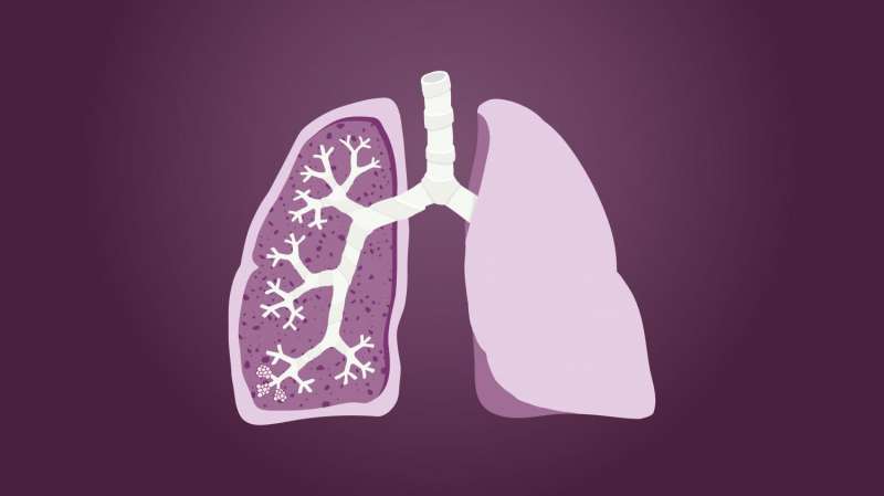 Exploring the cause of chronic lung transplant rejection, in a quest to stop it
