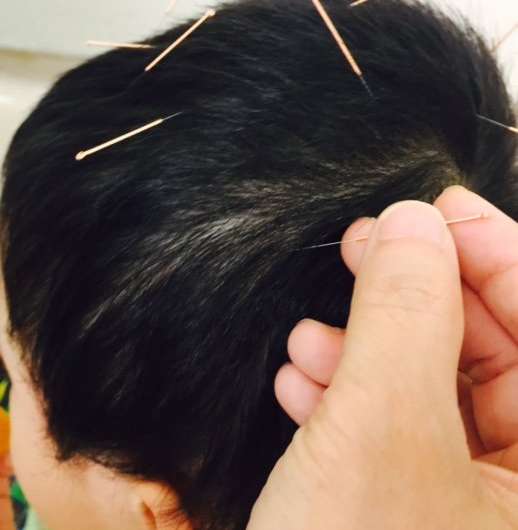 HKBU clinical study finds scalp acupuncture effective for treating autistic children