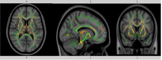 Is microstructural integrity of white matter tracts affected in older falling victims?
