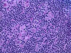 NEJM case reports show promise of cancer immunotherapy to treat rare lymphoma