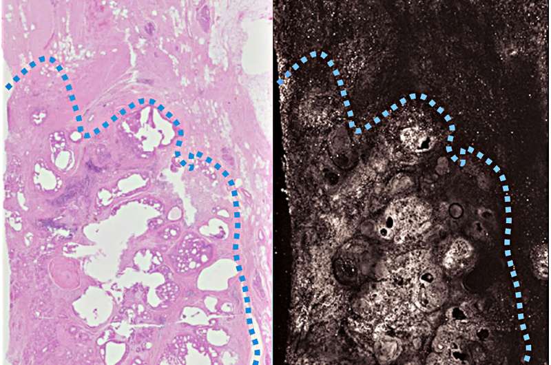 New imaging technique aims to ensure surgeons completely remove cancer