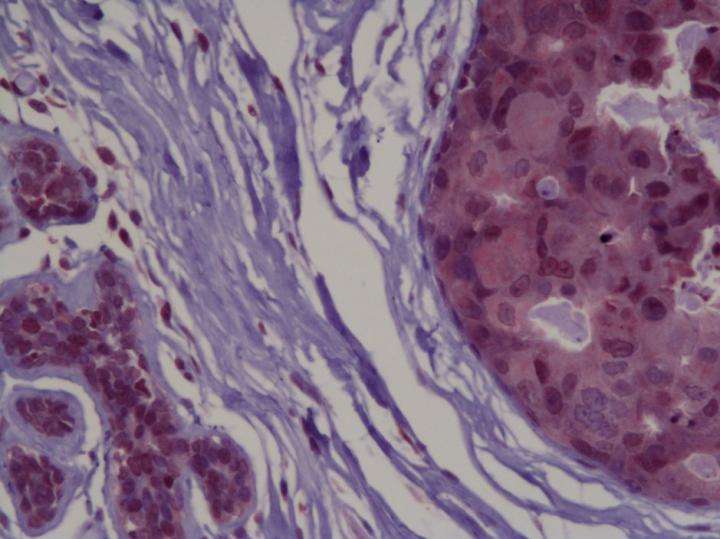 研究发现了抑制乳腺癌肿瘤生长的蛋白质