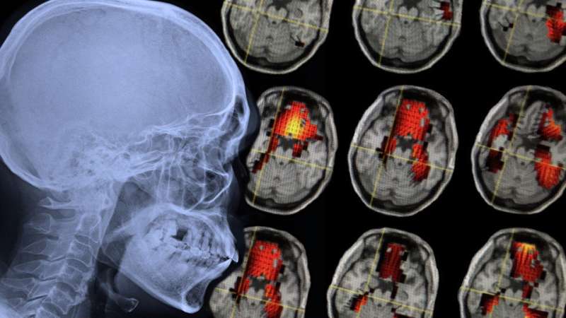 Study finds concussed brains take longer, must work harder to tackle memory tasks