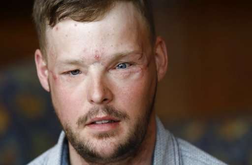 Tearful meeting for pair forever linked by face transplant