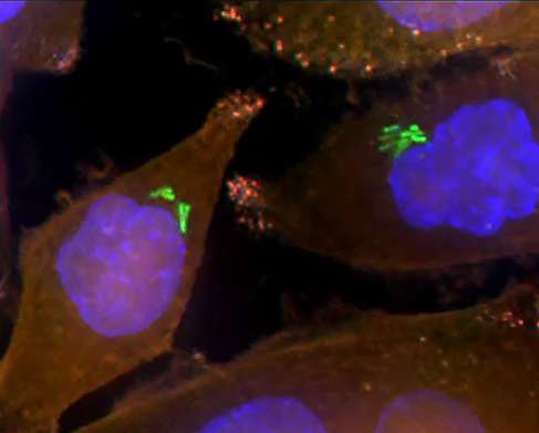 Scientists find bacteria in pancreatic tumors that metabolize a common drug