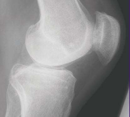 New therapeutic targets for osteoarthritis pain