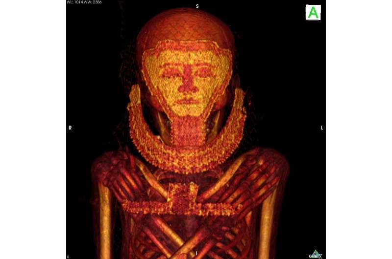 Oldest cases of breast cancer and myeloma revealed in scans of mummies