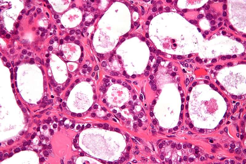 'Synthetic biomarkers' could be used to diagnose ovarian cancer months earlier than now possible