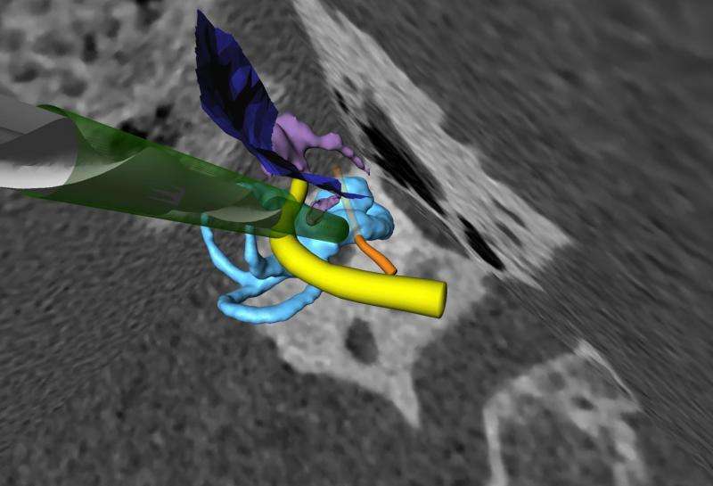 Researchers develop high-precision surgical robot for cochlear implantation