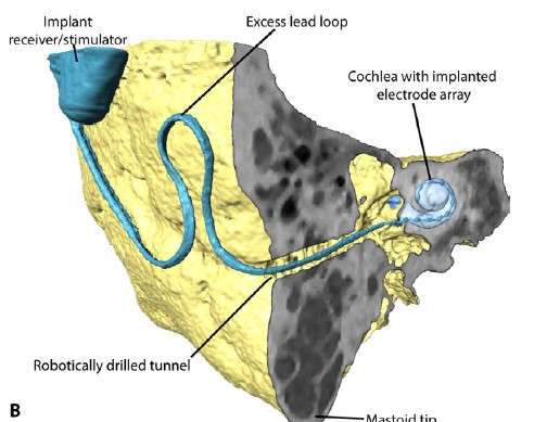 Researchers develop high-precision surgical robot for cochlear implantation