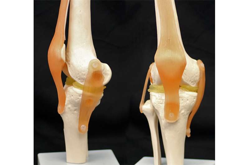 3-D-printable implants may ease damaged knees