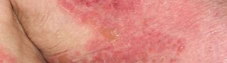 Clinical trial reveals a safer long term treatment for blistering skin disease