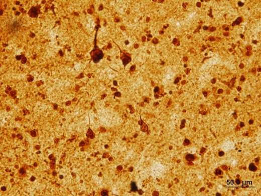 New insight into how brain cells die in Alzheimer's and FTD