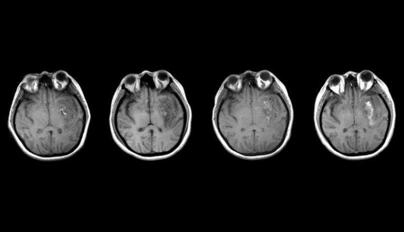 Researcher uses sophisticated techniques to understand traumatic brain injuries among older adults