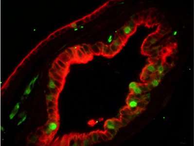 Research identifies cells that may be responsible for prostate cancer recurrence