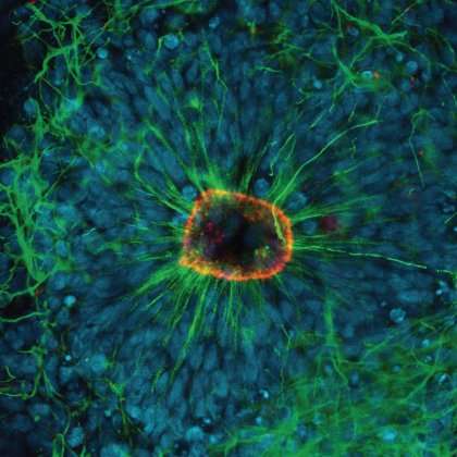 Researchers find neurological conditions could begin in the womb