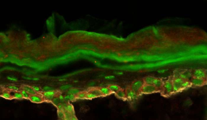 Researchers explore how protein production gets distorted in skin cancer