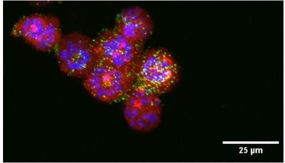 Researchers use nanoparticles to target, kill endometrial cancer