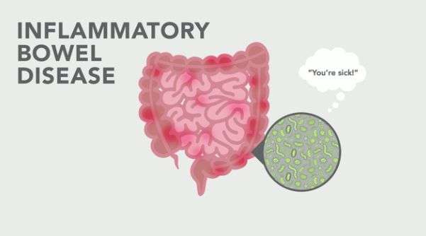 Microbiomes more in flux in patients with inflammatory bowel disease