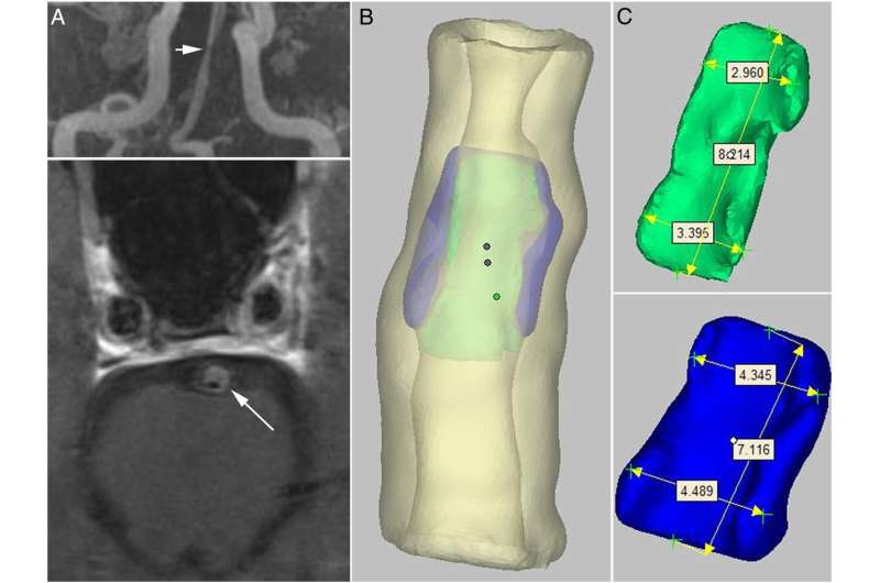 3-D-printed model of stenotic intracranial artery enables vessel-wall MRI standardization