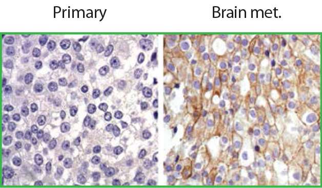 Brain microenvironment makes HER2-positive breast cancer metastases resistant to treatment