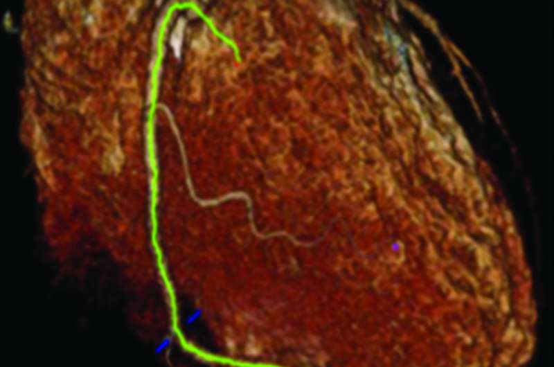 New way to see artery damage before heart disease sets in