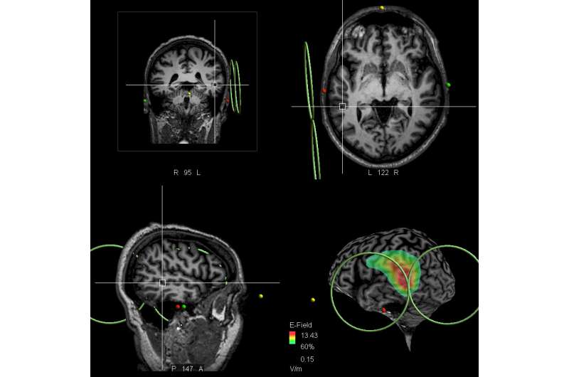 Scientists discover and target brain area in patients with schizophrenia who 'hear voices'