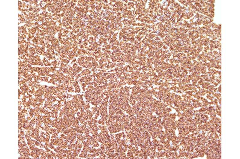 'Capicua' gene plays a key role in T-cell acute lymphoblastic leukaemia