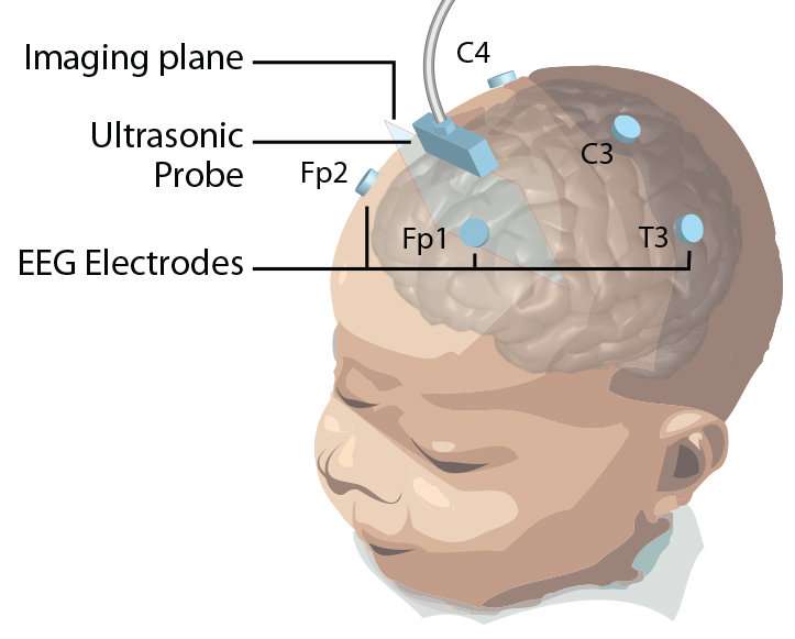 A portable tiny brain scanner for studying brain disorders in infants