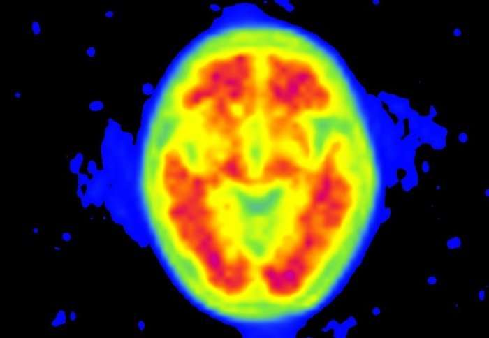 PET scans for Alzheimer's could bring benefit to more patients