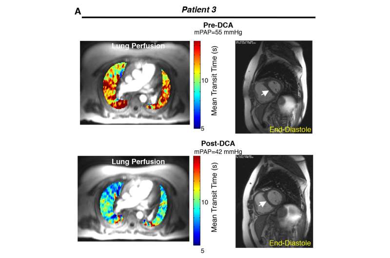 Targeting mitochondria in pulmonary hypertension