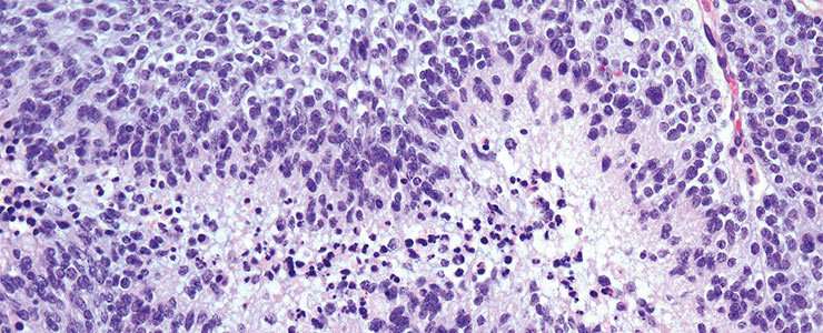 Novel mechanism that protects from glioblastoma identified