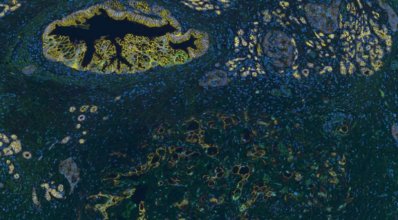 Researchers identify epigenetic orchestrator of pancreatic cancer cells