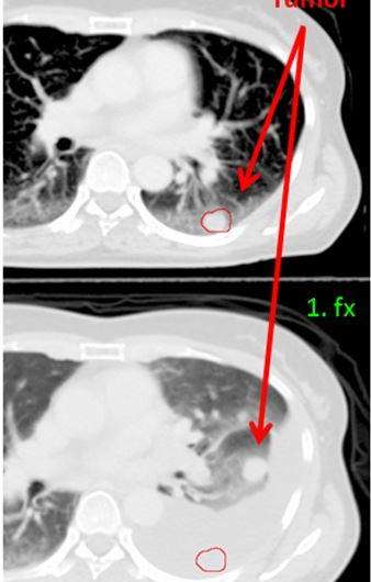 Adaptive radiotherapy reduces pneumonitis while controlling lung cancer